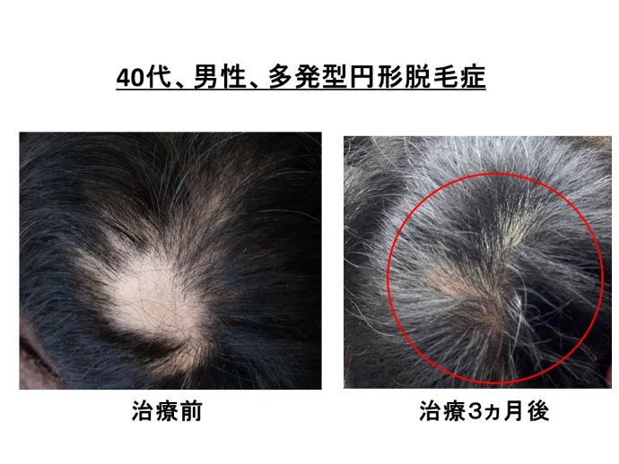円形脱毛症　病院